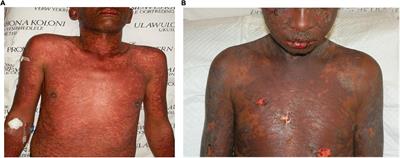 Disease severity and status in Stevens–Johnson syndrome and toxic epidermal necrolysis: Key knowledge gaps and research needs